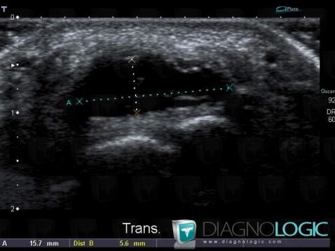 Kyste synovial, Autres parties molles/nerfs - Main, Echographie