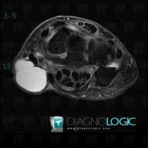 Kyste synovial, Autres parties molles/nerfs - Poignet, IRM