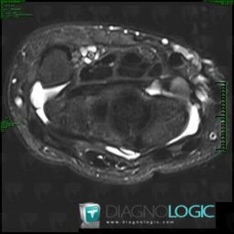 Kyste synovial, Autres parties molles/nerfs - Poignet, IRM