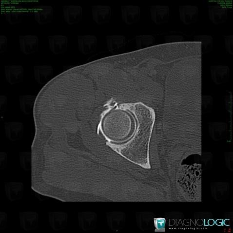 Labral lesion / Pelvis, Coxo femoral joint, CT