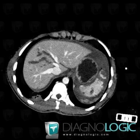 Laceration, Liver, CT