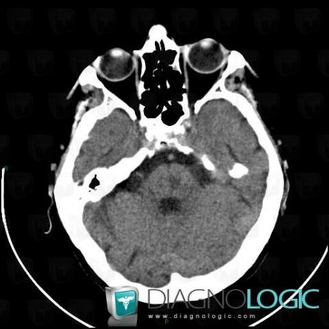 Lacunar infarct, Brainstem, Posterior fossa, CT