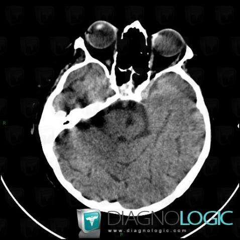 Lacunar infarct, Brainstem, Posterior fossa, CT