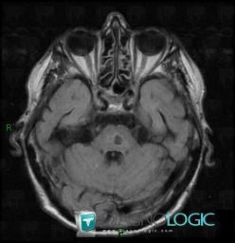 Lacunar infarct, Brainstem, Posterior fossa, MRI