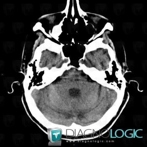 Lacunar infarct, Posterior fossa, CT