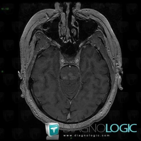 Langerhans cell histiocytosis, Brainstem, Posterior fossa, MRI