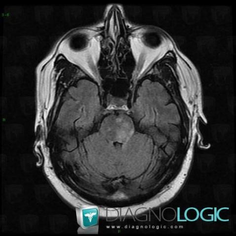 Langerhans cell histiocytosis, Brainstem, Posterior fossa, MRI