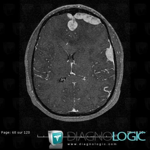 Langerhans cell histiocytosis, Cerebral falx / Midline, MRI