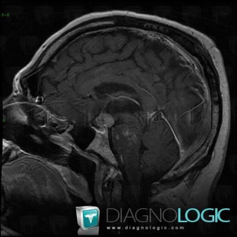 Langerhans cell histiocytosis, Cerebral falx / Midline, MRI