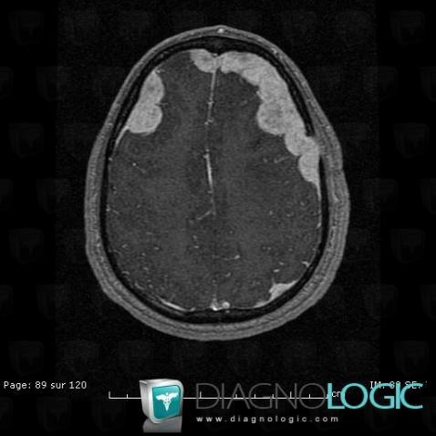 Langerhans cell histiocytosis, Cerebral hemispheres, MRI