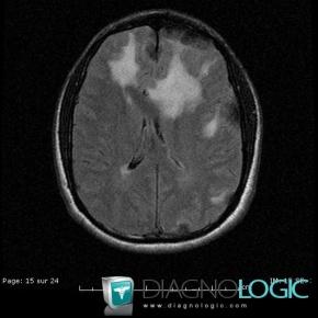 Langerhans cell histiocytosis, Cerebral hemispheres, MRI