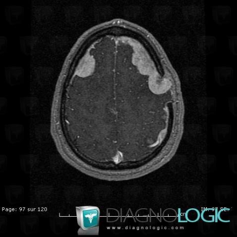 Langerhans cell histiocytosis, Cortico subcortical region, MRI