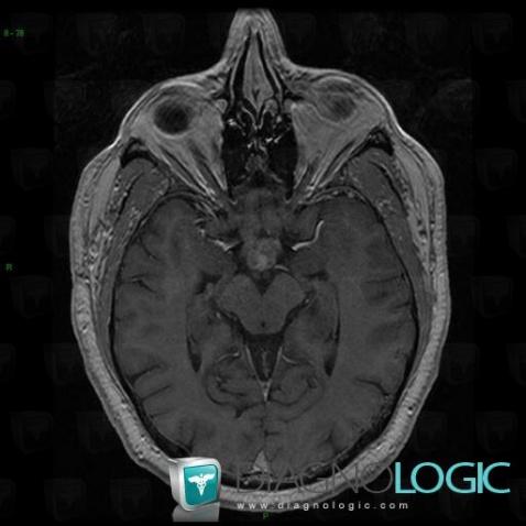 Langerhans cell histiocytosis, Pituitary gland and parasellar region, MRI