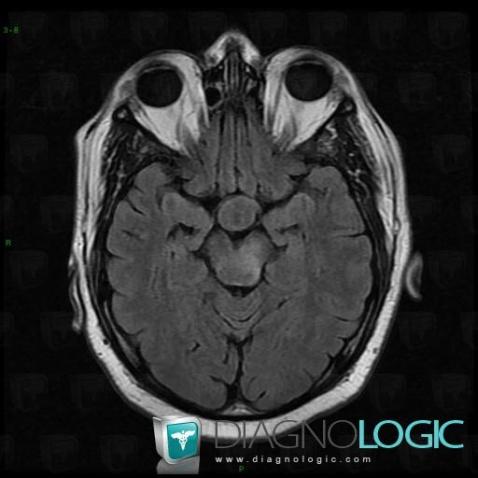 Langerhans cell histiocytosis, Pituitary gland and parasellar region, MRI