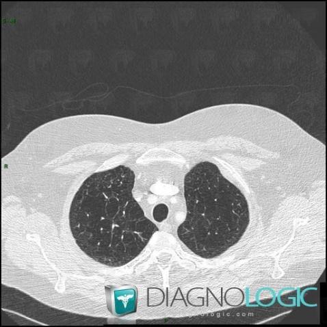 Langerhans cell histiocytosis, Pulmonary parenchyma, CT