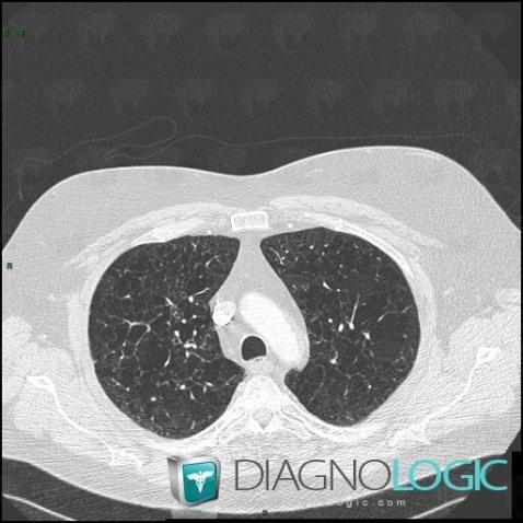 Langerhans cell histiocytosis, Pulmonary parenchyma, CT