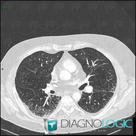 Langerhans cell histiocytosis, Pulmonary parenchyma, CT