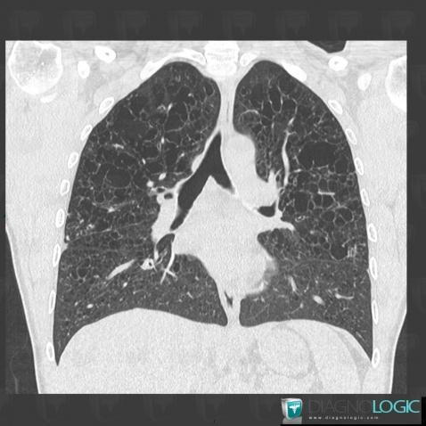 Langerhans cell histiocytosis, Pulmonary parenchyma, CT