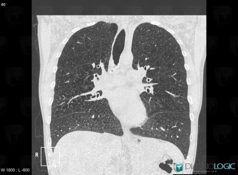 Langerhans cell histiocytosis, Pulmonary parenchyma, CT