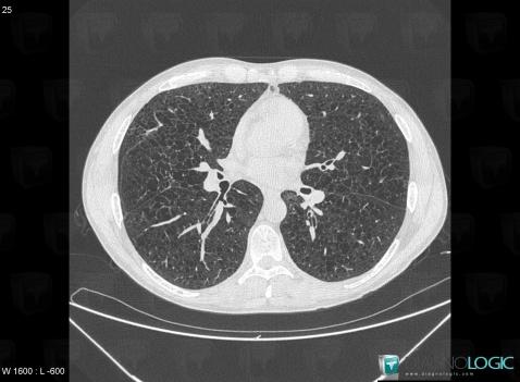 Langerhans cell histiocytosis, Pulmonary parenchyma, CT