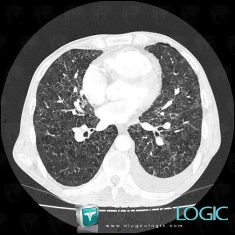 Langerhans cell histiocytosis, Pulmonary parenchyma, CT