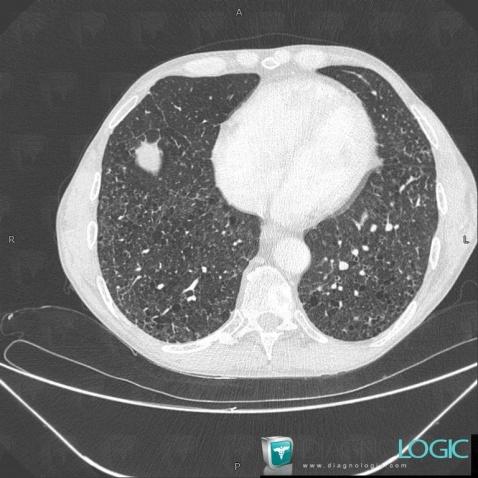 Langerhans cell histiocytosis, Pulmonary parenchyma, CT