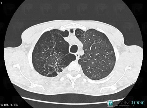 Langerhans cell histiocytosis, Pulmonary parenchyma, CT