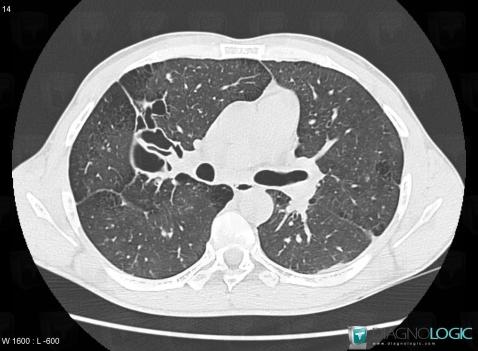 Langerhans cell histiocytosis, Pulmonary parenchyma, CT