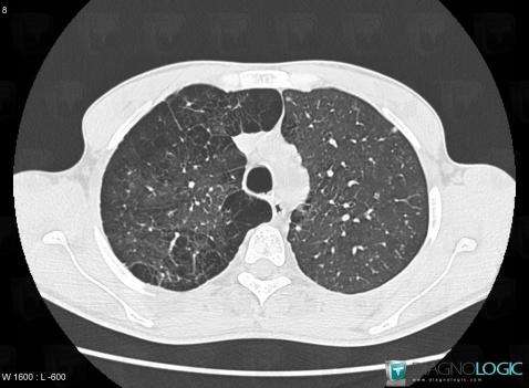 Langerhans cell histiocytosis, Pulmonary parenchyma, CT