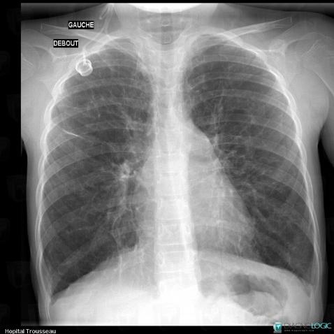 Langerhans cell histiocytosis, Pulmonary parenchyma, X rays