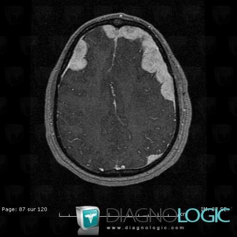 Langerhans cell histiocytosis, Supratentorial peri cerebral spaces, MRI