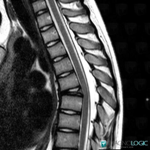 Langerhans cell histiocytosis, Vertebral body / Disk, MRI