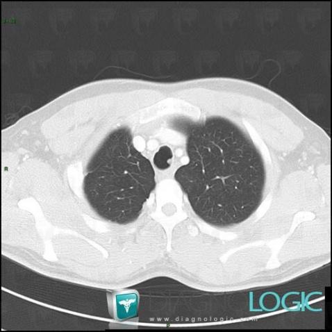 Laryngeal papillomatosis, Airways, CT