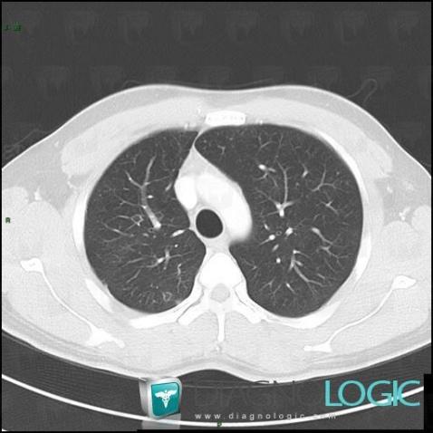 Laryngeal papillomatosis, Pulmonary parenchyma, CT