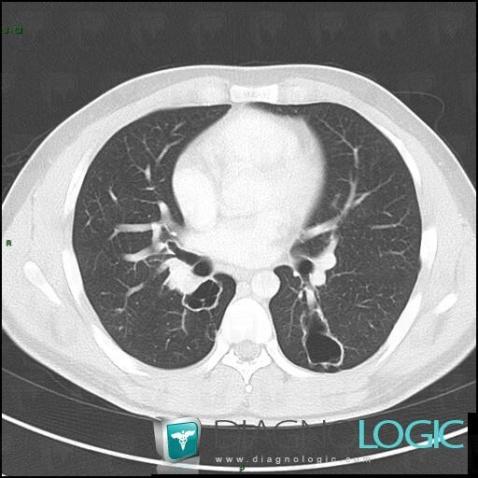 Laryngeal papillomatosis, Pulmonary parenchyma, CT