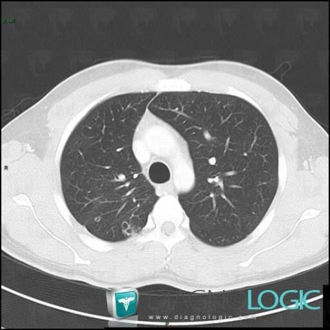 Laryngeal papillomatosis, Pulmonary parenchyma, CT