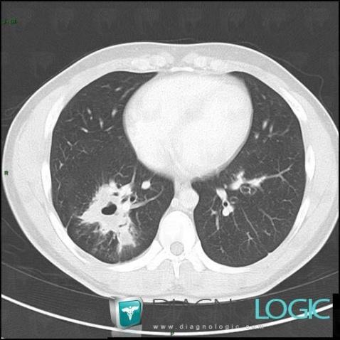 Laryngeal papillomatosis, Pulmonary parenchyma, CT