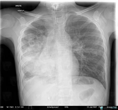 Radiology case : Laryngeal papillomatosis (X rays ,CT) - Diagnologic