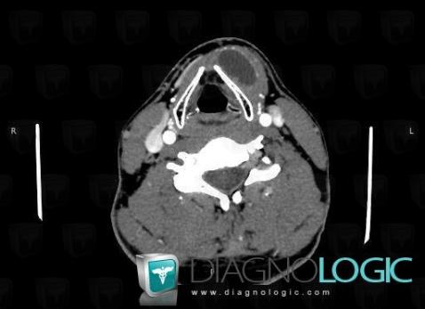 Laryngocele, Deep facial spaces, CT