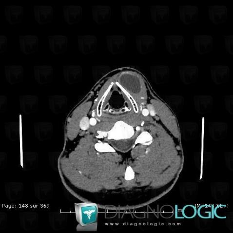 Laryngocele, Deep facial spaces, Deep neck spaces, CT