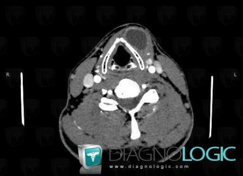 Laryngocele, Deep neck spaces, CT