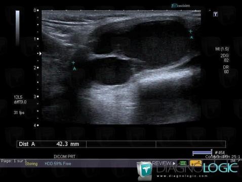 Laryngocele, Espaces profonds de-face, Espaces profonds-cou, Echographie