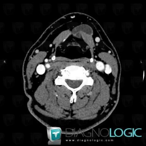 Laryngocele, Espaces profonds de-face, Pharyngolarynx, TDM