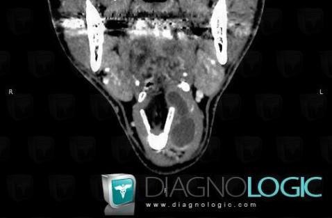 Laryngocele, Larynx, CT