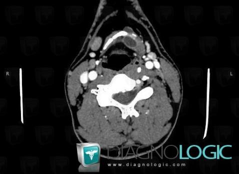 Laryngocele, Larynx, CT