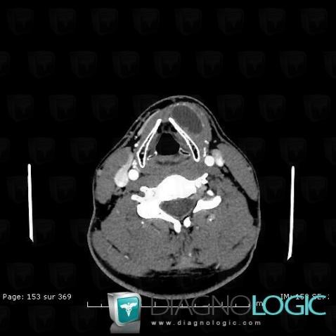 Laryngocele, Larynx, Espaces profonds-cou, TDM