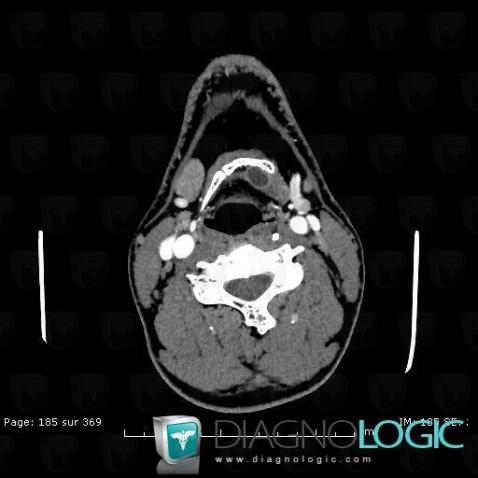 Laryngocele, Pharyngolarynx, Larynx, CT