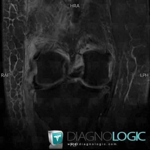 Lateral collateral ligament rupture / Knee, Lateral collateral ligament - Knee, MRI