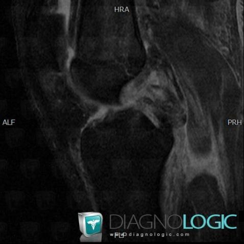 Lateral collateral ligament rupture / Knee, Lateral collateral ligament - Knee, MRI