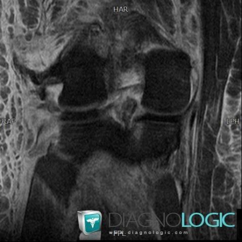 Lateral collateral ligament rupture / Knee, Lateral collateral ligament - Knee, MRI